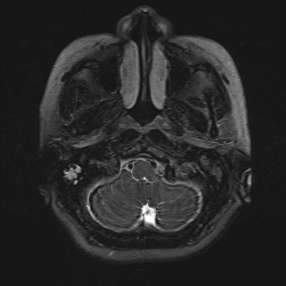 Cerebellopontine angle meningioma (Radiopaedia 53561-59591 Axial 3D volume T2 19).jpg