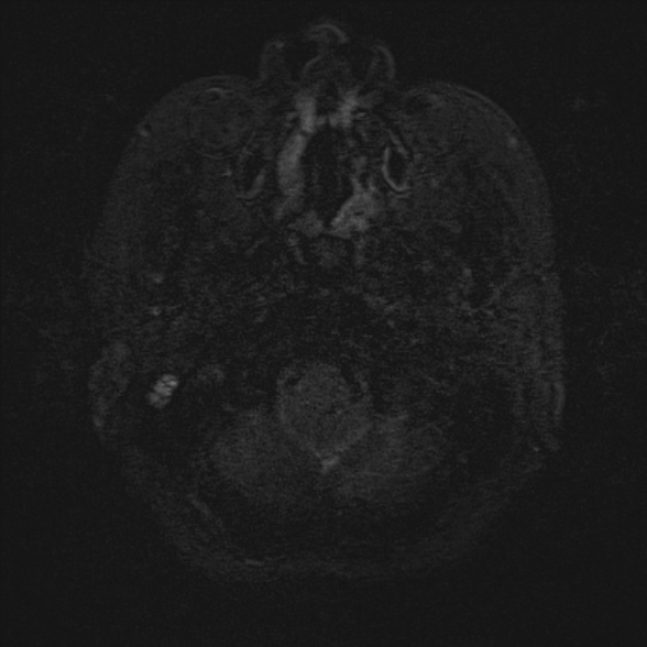Cerebellopontine angle meningioma (Radiopaedia 53561-59591 Axial 3D volume T2 3).jpg