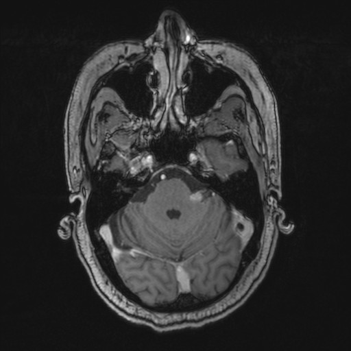 File:Cerebellopontine tumor (Radiopaedia 19331).jpg