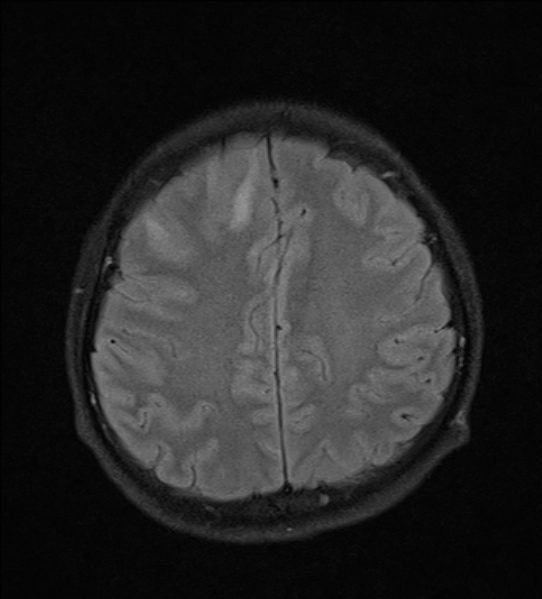 File:Cerebral abscess (Radiopaedia 24212-24478 Axial FLAIR 20).jpg