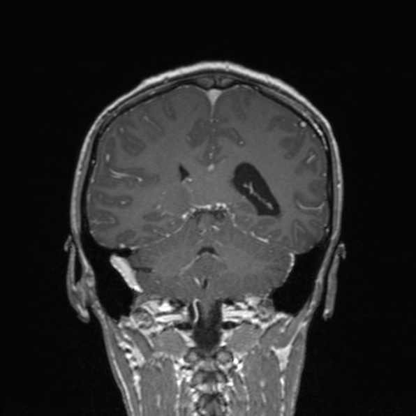 Cerebral abscess (Radiopaedia 24212-24478 Coronal T1 C+ 138).jpg