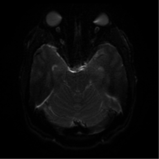 File:Cerebral abscess (Radiopaedia 57774-64740 Axial DWI 38).png