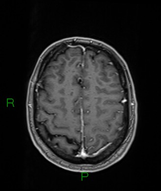 Cerebral abscess and subdural empyema (Radiopaedia 84436-99779 Axial T1 C+ 23).jpg