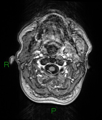 File:Cerebral abscess and subdural empyema (Radiopaedia 84436-99779 Axial T1 C+ 85).jpg