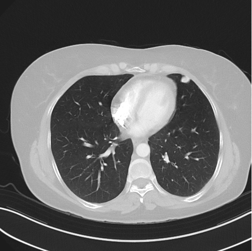 File:Cerebral abscess from pulmonary arteriovenous malformation (Radiopaedia 86275-102292 Axial lung window 38).png