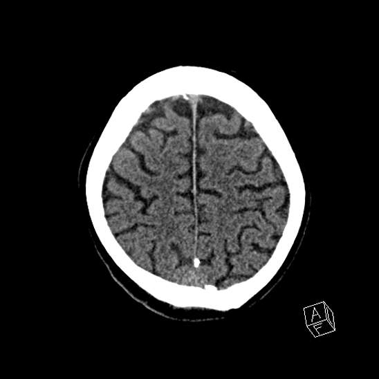 Cerebral abscess with ventriculitis (Radiopaedia 78965-91876 Axial non-contrast 40).jpg