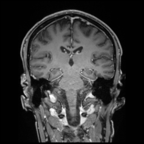 Cerebral abscess with ventriculitis (Radiopaedia 78965-91878 Coronal T1 C+ 37).jpg
