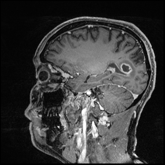 Cerebral abscess with ventriculitis (Radiopaedia 78965-91878 Sagittal T1 C+ 63).jpg