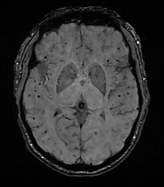 File:Cerebral amyloid angiopathy (Radiopaedia 46082-50433 Axial SWI 41).png