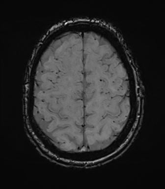 Cerebral amyloid angiopathy (Radiopaedia 46082-50433 Axial SWI 67).png