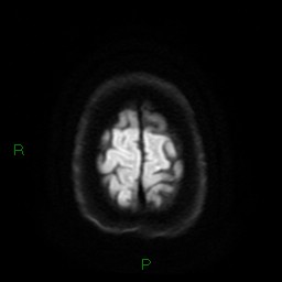 Cerebral amyloid angiopathy (Radiopaedia 77506-89664 Axial DWI 26).jpg