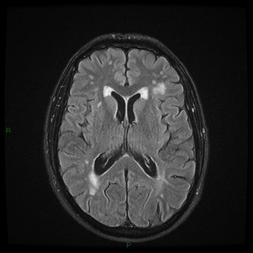 File:Cerebral amyloid angiopathy (Radiopaedia 77506-89664 Axial FLAIR 16).jpg