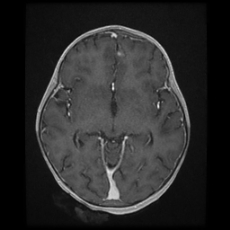 Cerebral and spinal tuberculosis (Radiopaedia 90489-107837 Axial T1 C+ 95).jpg