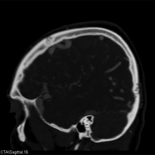 File:Cerebral arteriovenous malformation (Radiopaedia 28518-28759 D 13).jpg