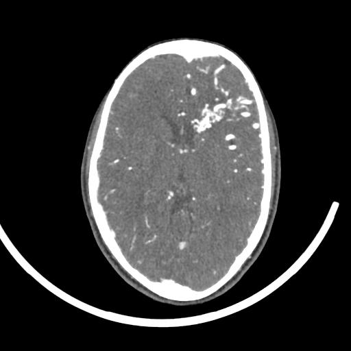 Cerebral arteriovenous malformation (Radiopaedia 29531-30031 E 7).jpg