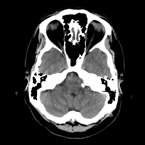 File:Cerebral arteriovenous malformation (Radiopaedia 39259-41505 Brain Ax 5mm 6).png