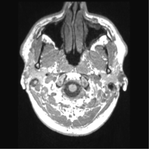 File:Cerebral arteriovenous malformation (Radiopaedia 39259-41506 Axial T1 6).png
