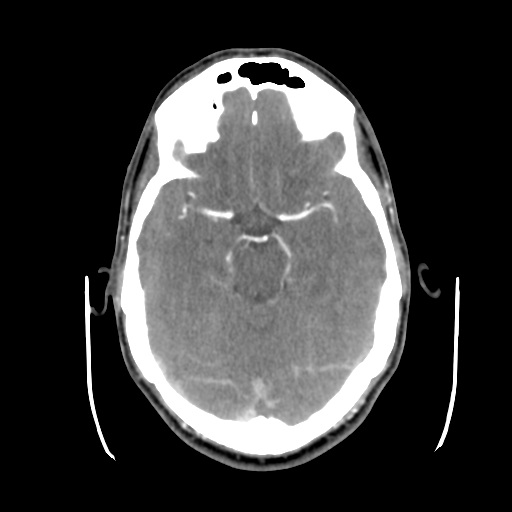 Cerebral arteriovenous malformation (Radiopaedia 55798-62371 B 19).png