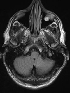 File:Cerebral arteriovenous malformation (Radiopaedia 55798-62372 Axial FLAIR 3).png