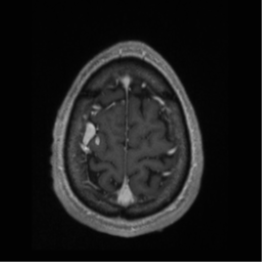 Cerebral arteriovenous malformation (Radiopaedia 55798-62372 Axial T1 C+ 68).png