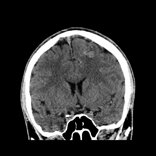File:Cerebral arteriovenous malformation (Radiopaedia 61964-70028 Coronal non-contrast 25).jpg
