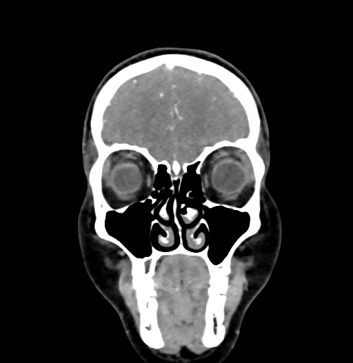 Cerebral arteriovenous malformation (Radiopaedia 73830-84645 C 18).jpg
