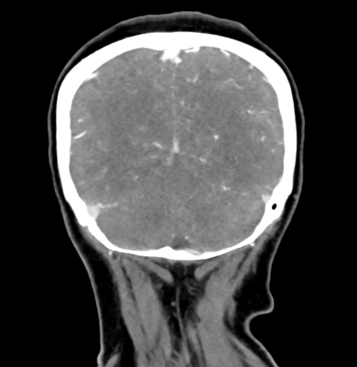Cerebral arteriovenous malformation (Radiopaedia 73830-84645 C 78).jpg