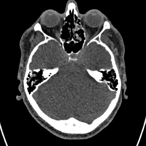 File:Cerebral arteriovenous malformation (Radiopaedia 78188-90746 Axial non-contrast 51).jpg