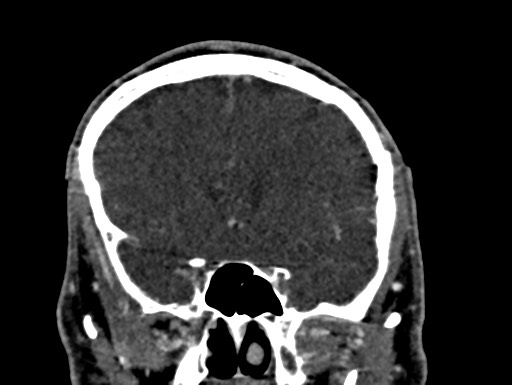 Cerebral arteriovenous malformation (Radiopaedia 78188-90746 Coronal C+ delayed 37).jpg
