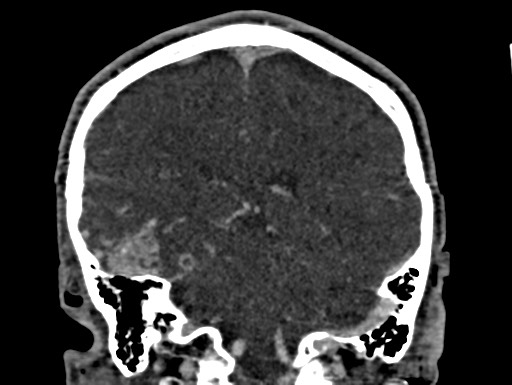 Cerebral arteriovenous malformation (Radiopaedia 78188-90746 Coronal C+ delayed 78).jpg