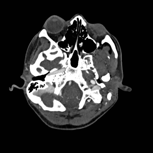 File:Cerebral arteriovenous malformation (Radiopaedia 79677-92888 A 3).jpg