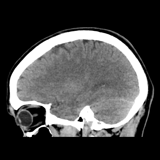 Cerebral arteriovenous malformation (Spetzler-Martin grade 2) (Radiopaedia 41262-44076 A 43).png