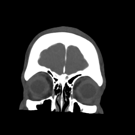 File:Cerebral arteriovenous malformation (Spetzler-Martin grade 2) (Radiopaedia 41262-44076 F 8).png