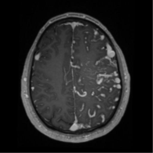 Cerebral arteriovenous malformation - huge (Radiopaedia 35734-37272 Axial T1 C+ 54).png