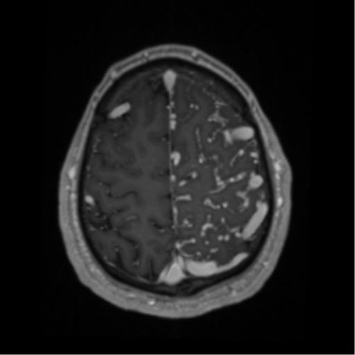 Cerebral arteriovenous malformation - huge (Radiopaedia 35734-37272 Axial T1 C+ 61).png
