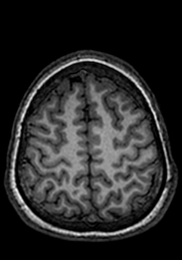 Cerebral arteriovenous malformation at posterior body of corpus callosum (Radiopaedia 74111-84925 Axial T1 47).jpg