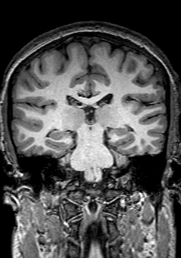 Cerebral arteriovenous malformation at posterior body of corpus callosum (Radiopaedia 74111-84925 Coronal T1 198).jpg