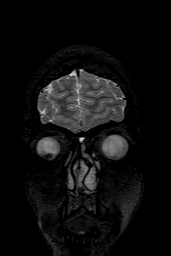 Cerebral arteriovenous malformation at posterior body of corpus callosum (Radiopaedia 74111-84925 Coronal T2 11).jpg