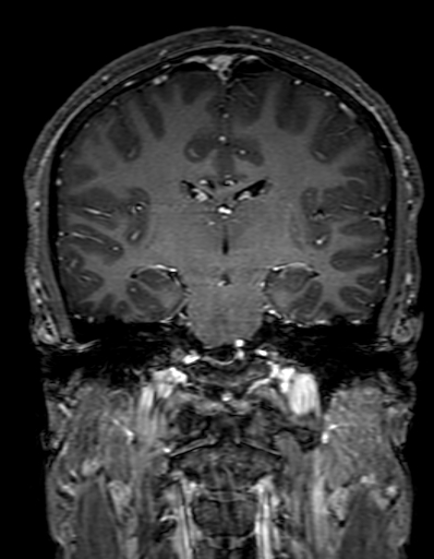 Cerebral arteriovenous malformation at posterior body of corpus callosum (Radiopaedia 74111-84925 K 197).jpg