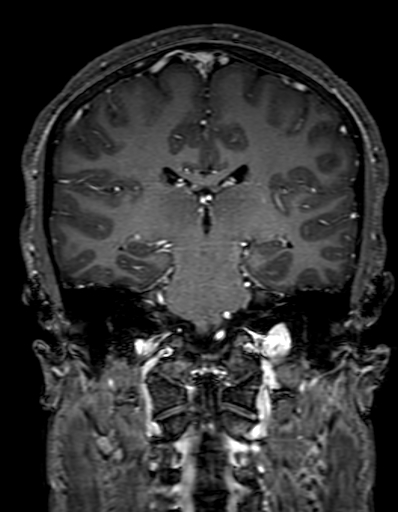 Cerebral arteriovenous malformation at posterior body of corpus callosum (Radiopaedia 74111-84925 K 211).jpg