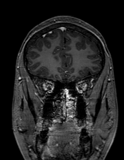Cerebral arteriovenous malformation at posterior body of corpus callosum (Radiopaedia 74111-84925 K 80).jpg