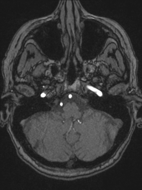 Cerebral arteriovenous malformation with hemorrhage (Radiopaedia 34422-35737 Axial MRA 14).png