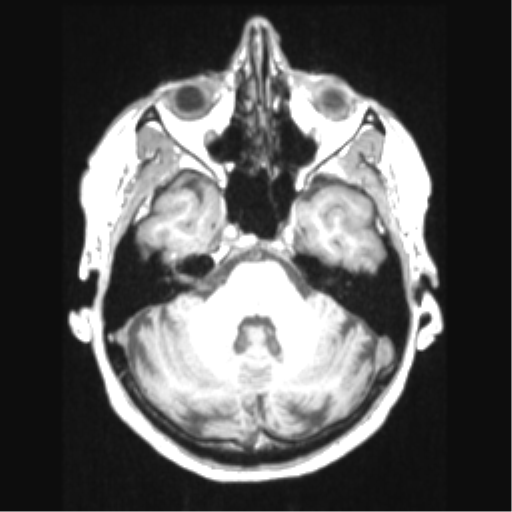 Cerebral arteriovenous malformation with hemorrhage (Radiopaedia 34422-35737 Axial T1 21).png