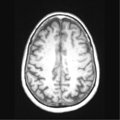 Cerebral arteriovenous malformation with hemorrhage (Radiopaedia 34422-35737 Axial T1 55).png