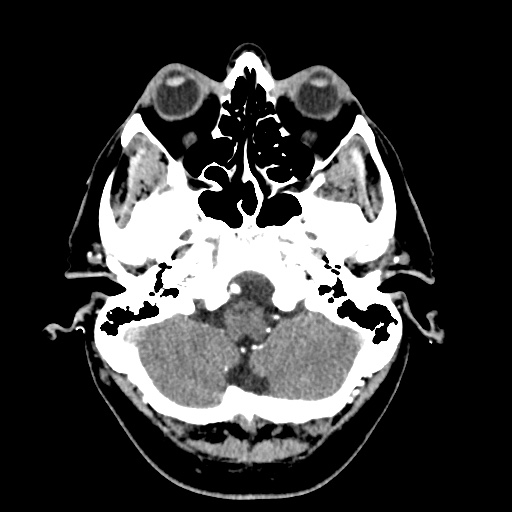 Cerebral arteriovenous malformation with lobar hemorrhage (Radiopaedia 35598-57216 A 10).jpg