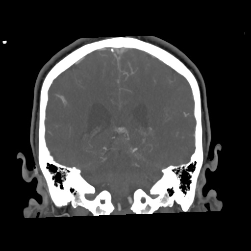 Cerebral arteriovenous malformation with lobar hemorrhage (Radiopaedia 35598-57216 C 60).jpg