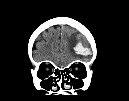 Cerebral arteriovenous malformation with lobar hemorrhage (Radiopaedia 44725-48510 Coronal non-contrast 14).png