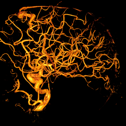 Cerebral arteriovenous malformation with lobar hemorrhage (Radiopaedia 44725-48513 Lateral 49).png