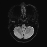 Cerebral cavernous venous malformation (Radiopaedia 70008-80021 Axial DWI 36).jpg