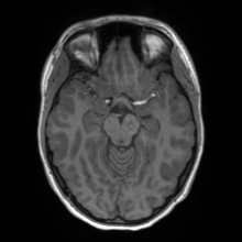 Cerebral cavernous venous malformation (Radiopaedia 70008-80021 Axial T1 28).jpg
